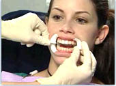 отбеливание зубов подготовка