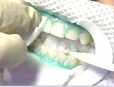 отбеливание зубов нанесение геля