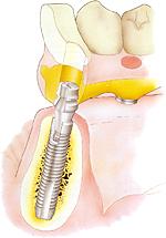 имплантация зубов astra tech (астра тек) на dental-implantology.ru