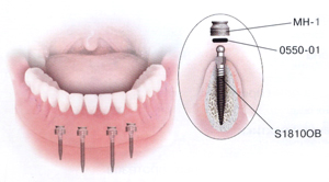 Зубные мини импланты