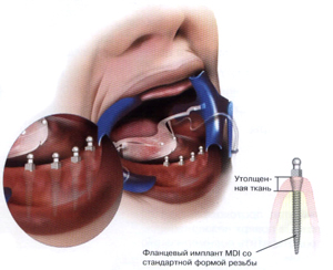 Протезирование на мини имплантах