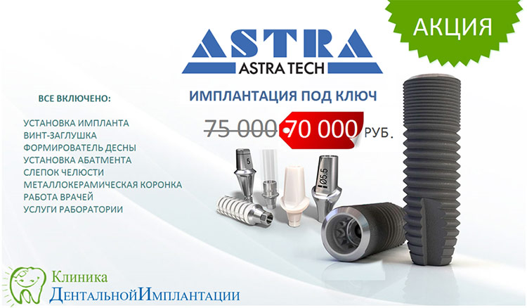 Импланты Astra Tec (Астра Тек) под ключ на dental-implantology.ru