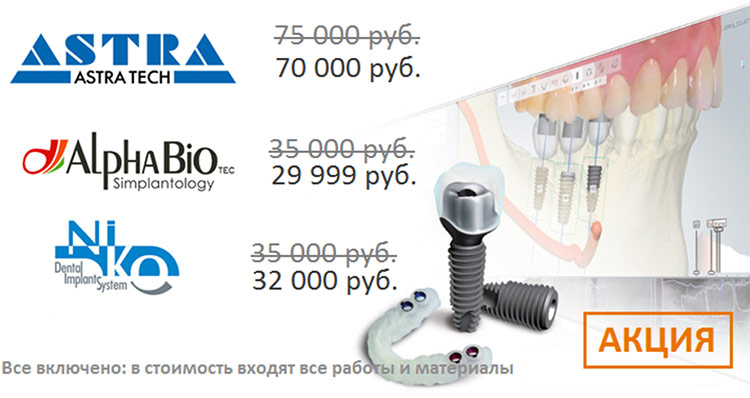 Стоимость Имплантов Зубов