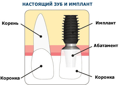 Импланты Bicon цены