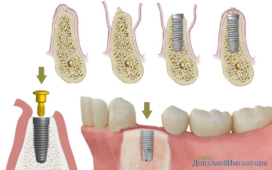 Зубы импланты поэтапно. Формирователь десны на имплант что такое. Этапы имплантации зубов. Имплантация зубов хирургический этап.