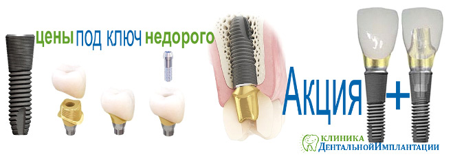 Клиника имплантации зубов в Москве цены акции на dental-implantology.ru